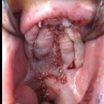 Cleft lip and palate Before & After Patient #2356