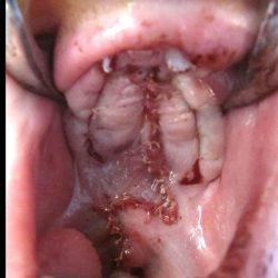 Cleft lip and palate Before & After Patient #2356