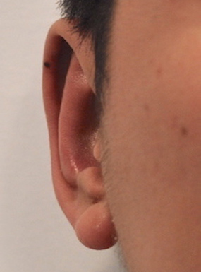 Otoplasty Before & After Patient #2296