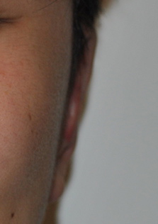 Otoplasty Before & After Patient #2296
