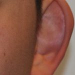 Otoplasty Before & After Patient #2296