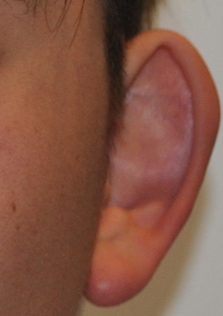 Otoplasty Before & After Patient #2296