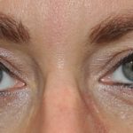 Neuromodulators Before & After Patient #2336