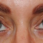 Neuromodulators Before & After Patient #2336