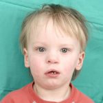 Cleft lip and palate Before & After Patient #2359