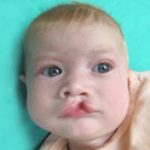 Cleft lip and palate Before & After Patient #2362