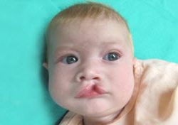 Cleft lip and palate Before & After Patient #2362