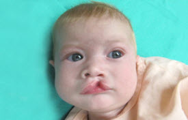 Cleft lip and palate Before & After Patient #2362