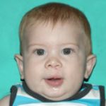 Cleft lip and palate Before & After Patient #2362
