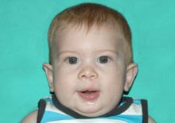 Cleft lip and palate Before & After Patient #2362