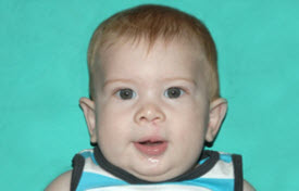 Cleft lip and palate Before & After Patient #2362