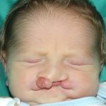 Cleft lip and palate Before & After Patient #2369