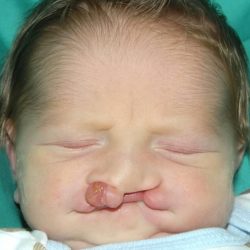 Cleft lip and palate Before & After Patient #2369