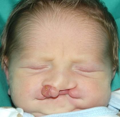 Cleft lip and palate Before & After Patient #2369