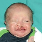 Cleft lip and palate Before & After Patient #2359