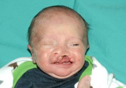 Cleft lip and palate Before & After Patient #2359