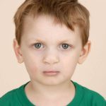 Cleft lip and palate Before & After Patient #2369