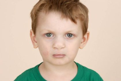 Cleft lip and palate Before & After Patient #2369