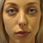 Fillers Before & After Patient #2767