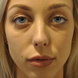 Fillers Before & After Patient #2767