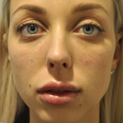 Fillers Before & After Patient #2767
