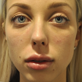 Fillers Before & After Patient #2767