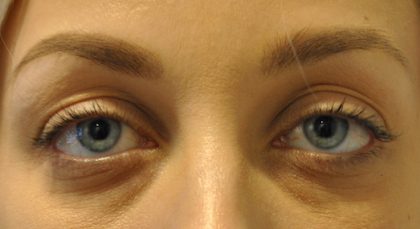Fillers Before & After Patient #2767