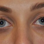 Fillers Before & After Patient #2767