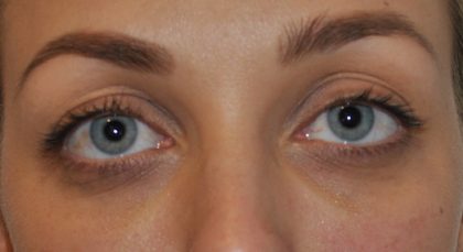 Fillers Before & After Patient #2767