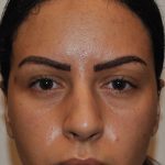 Fillers Before & After Patient #2795