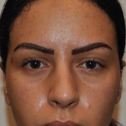 Fillers Before & After Patient #2795