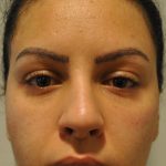 Fillers Before & After Patient #2795