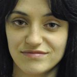 Fillers Before & After Patient #2798