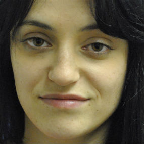 Fillers Before & After Patient #2798