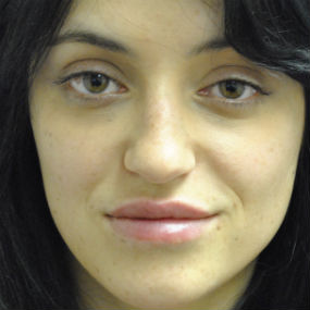 Fillers Before & After Patient #2798