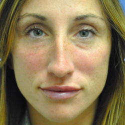 Fillers Before & After Patient #2804