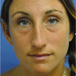 Fillers Before & After Patient #2804
