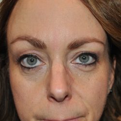Fillers Before & After Patient #2807