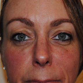 Fillers Before & After Patient #2807