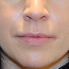 Fillers Before & After Patient #2810