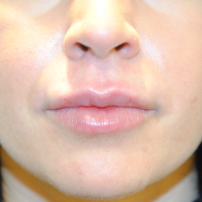 Fillers Before & After Patient #2810