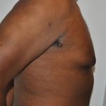 Gynecomastia Before & After Patient #2351