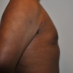 Gynecomastia Before & After Patient #2351