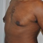 Gynecomastia Before & After Patient #2351