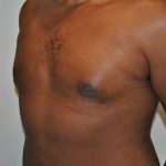 Gynecomastia Before & After Patient #2351