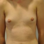 Natural Breast Augmentation Before & After Patient #2683