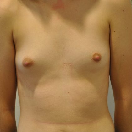 Natural Breast Augmentation Before & After Patient #2683