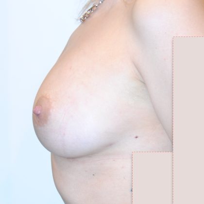 Natural Breast Augmentation Before & After Patient #2699