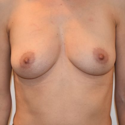 Natural Breast Augmentation Before & After Patient #2718