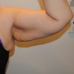 Arm Lift Before & After Patient #2596